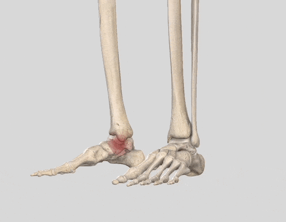 足関節内果の疲労骨折が生じる箇所