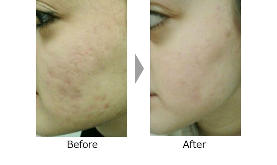 ダーマペン4の施術前後の比較①