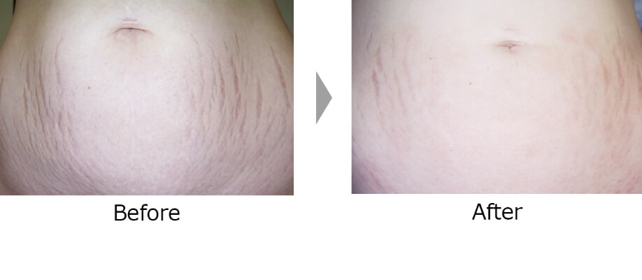 ダーマペン4の施術前後の比較②