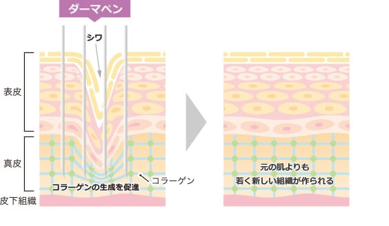 ダーマペン４のメカニズム