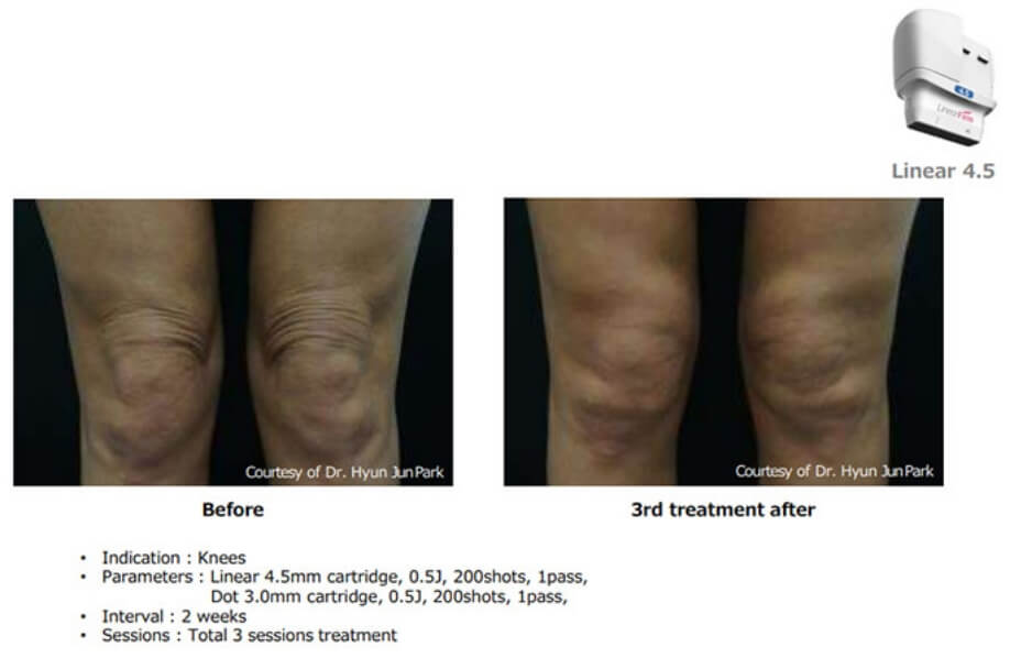 リニアファーム施術前後の比較①