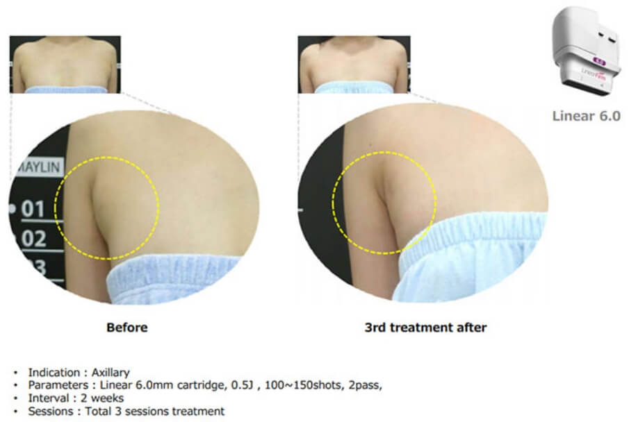 リニアファーム施術前後の比較②