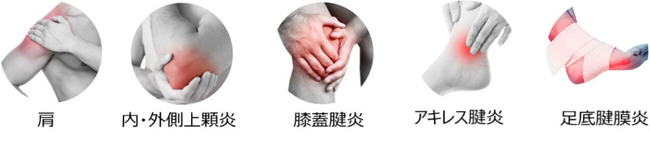 TENEXの適応部位・症状