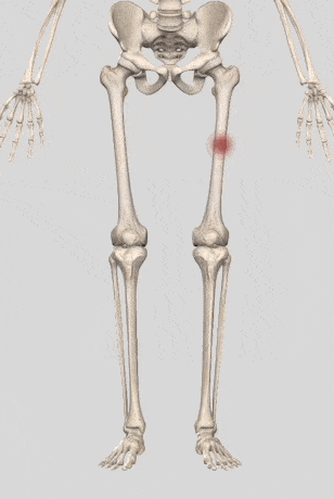 大腿骨の疲労骨折が生じる箇所