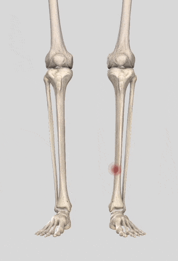 脛骨の疲労骨折が生じる箇所