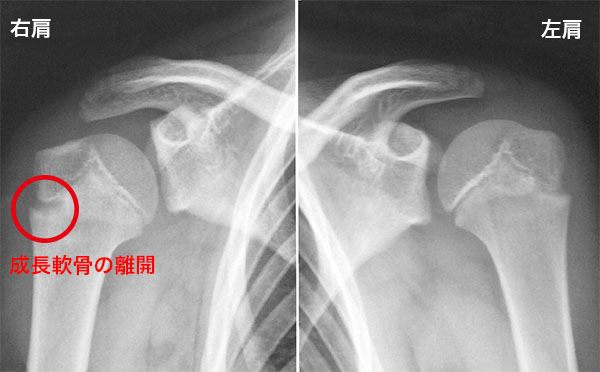 リトルリーグショルダー（上腕骨骨端線離開）のレントゲン
