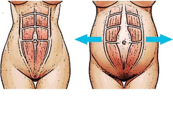 腹直筋離開のメカニズムのイラスト